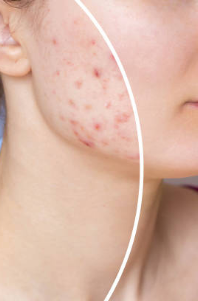 Acne, igmentation, Skin Care Consultation